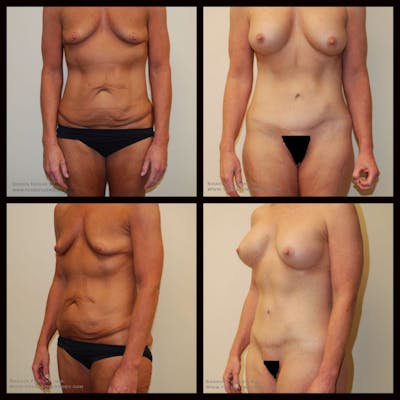Mommy Makeover Before & After Gallery - Patient 268300 - Image 1