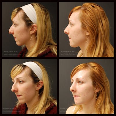 Rhinoplasty (Nose Job) Before & After Gallery - Patient 702983 - Image 1