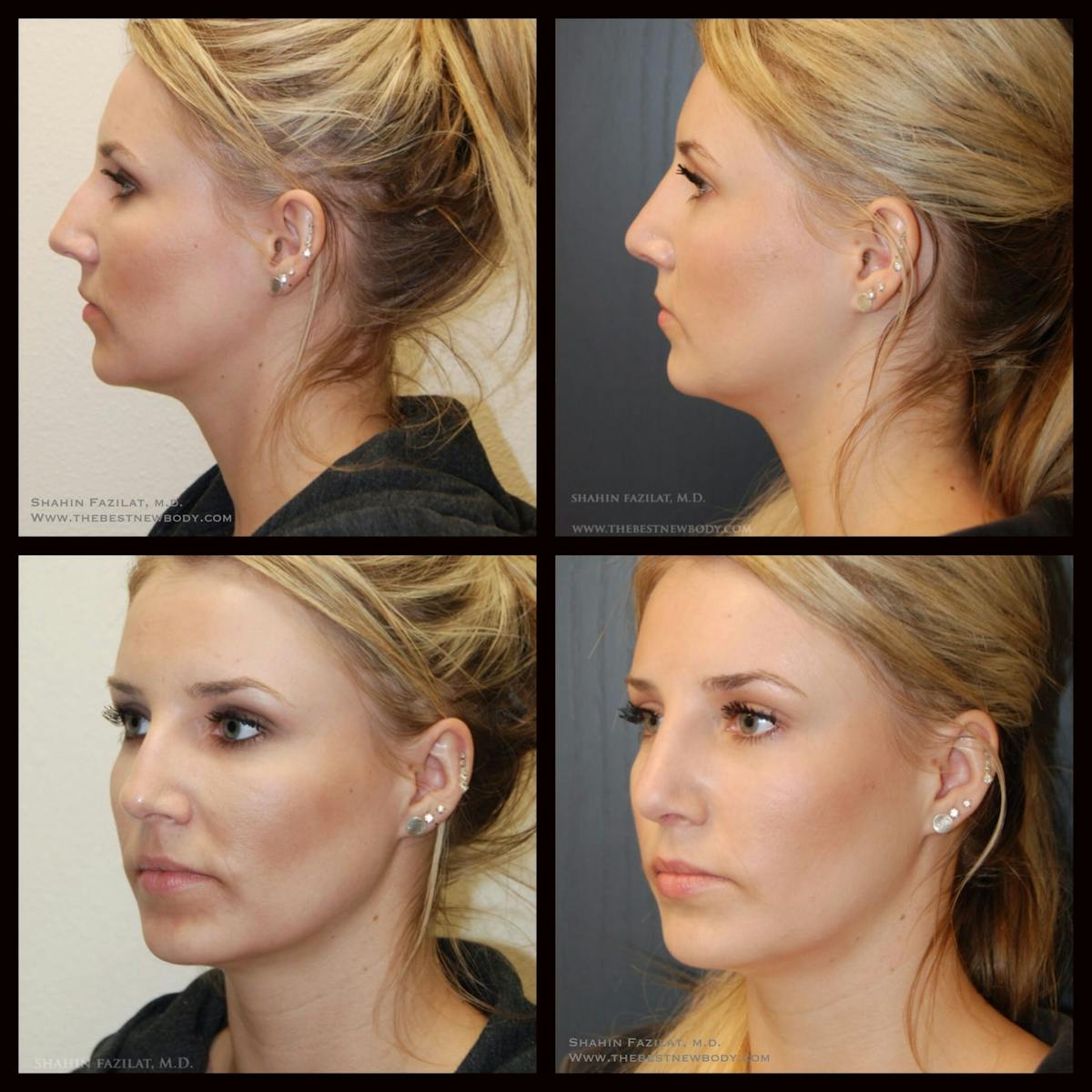 Rhinoplasty (Nose Job) Before & After Gallery - Patient 703985 - Image 1