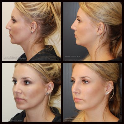 Rhinoplasty (Nose Job) Before & After Gallery - Patient 703985 - Image 1