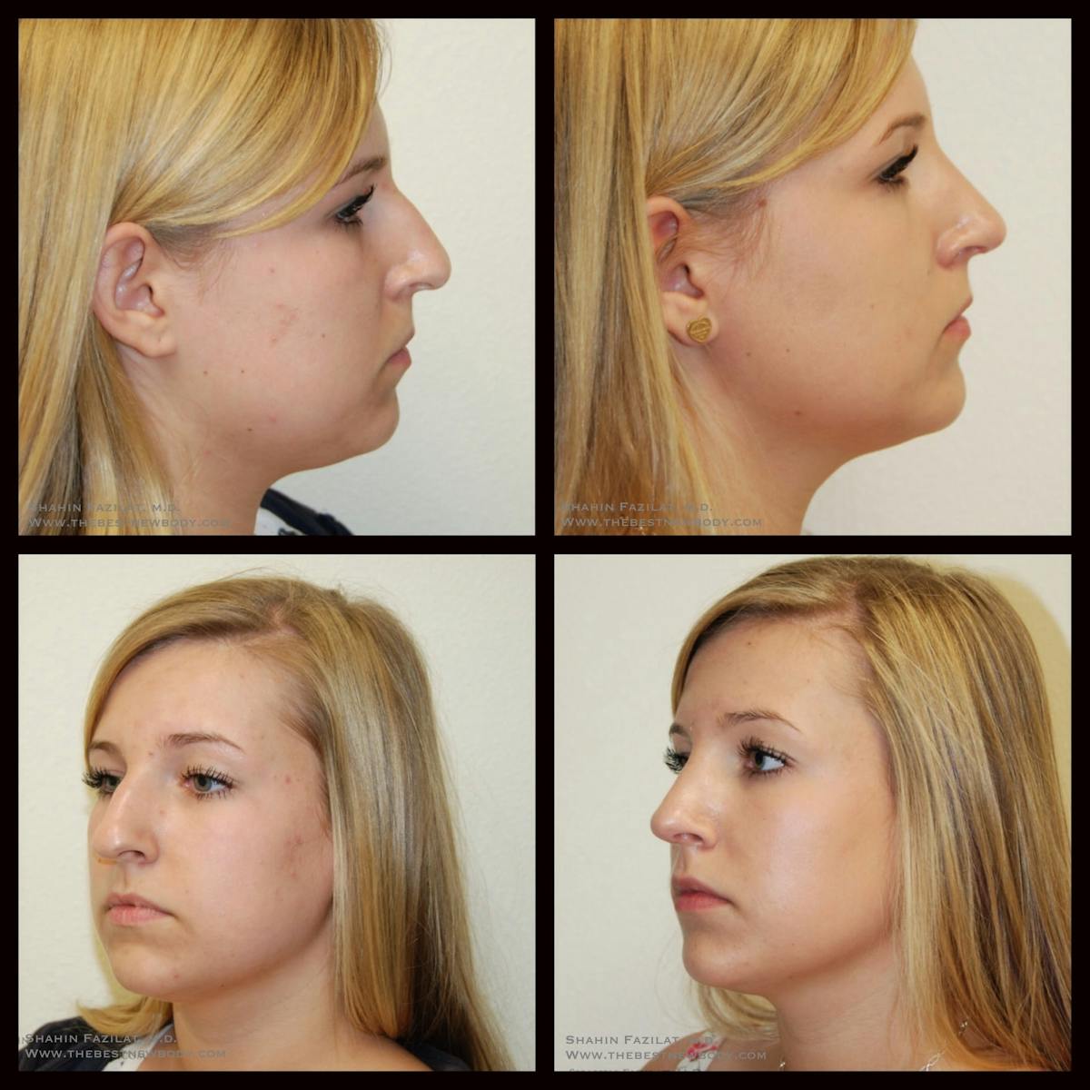 Rhinoplasty (Nose Job) Before & After Gallery - Patient 155876 - Image 1