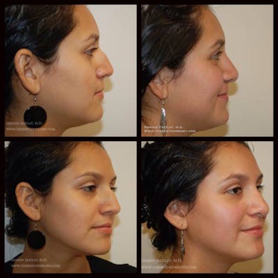 Rhinoplasty (Nose Job) Before & After Gallery - Patient 305189 - Image 1