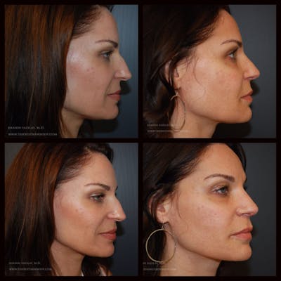 Rhinoplasty (Nose Job) Before & After Gallery - Patient 856035 - Image 1