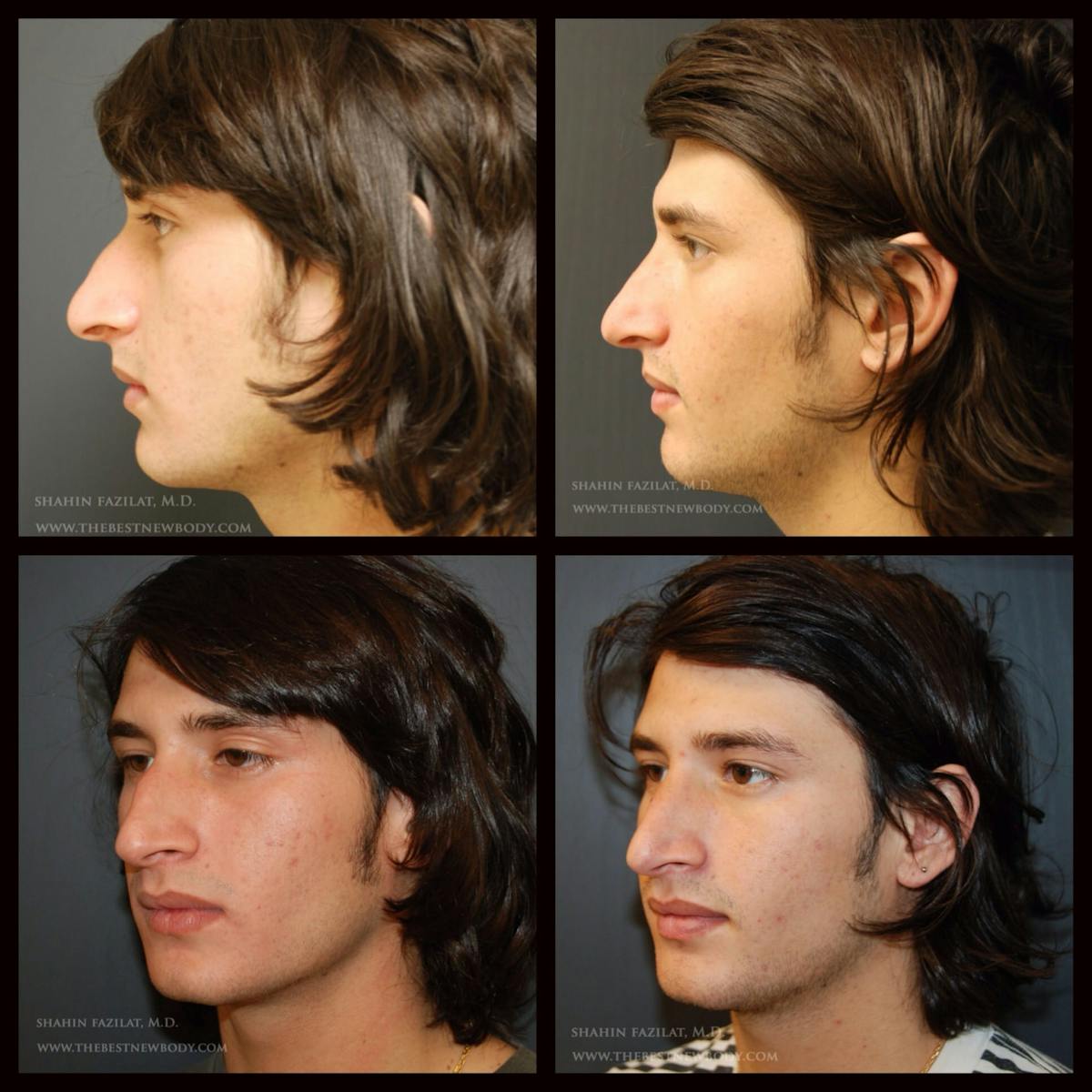 Rhinoplasty (Nose Job) Before & After Gallery - Patient 221230 - Image 1