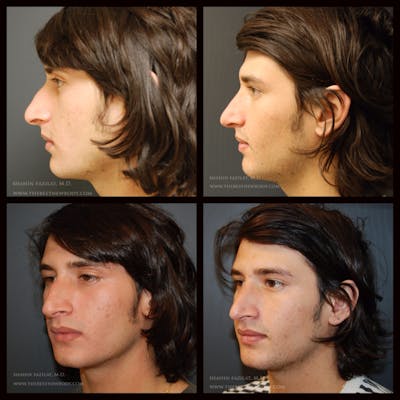 Rhinoplasty (Nose Job) Before & After Gallery - Patient 221230 - Image 1