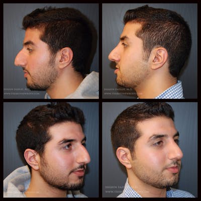Rhinoplasty (Nose Job) Before & After Gallery - Patient 107776 - Image 1