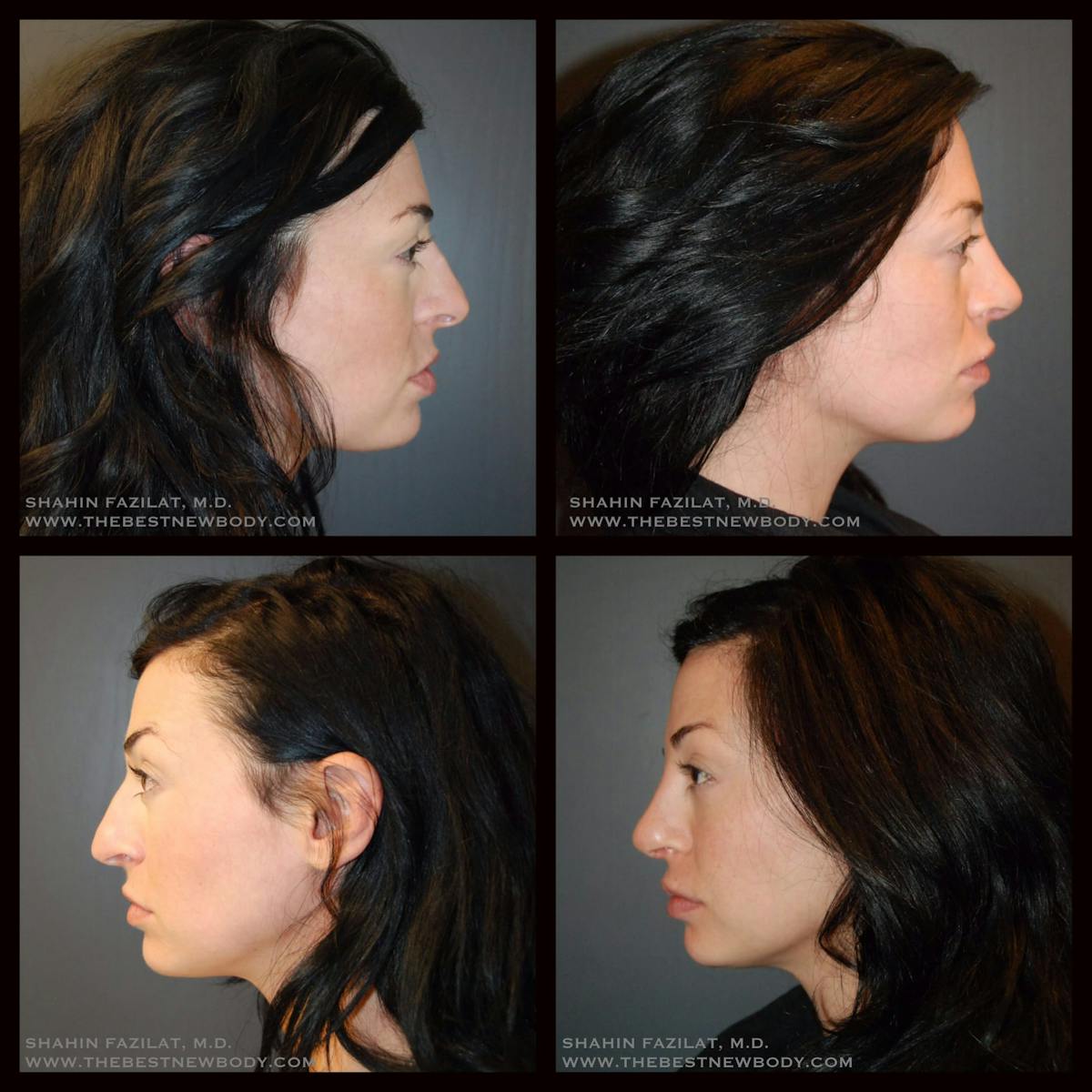 Rhinoplasty (Nose Job) Before & After Gallery - Patient 775798 - Image 1