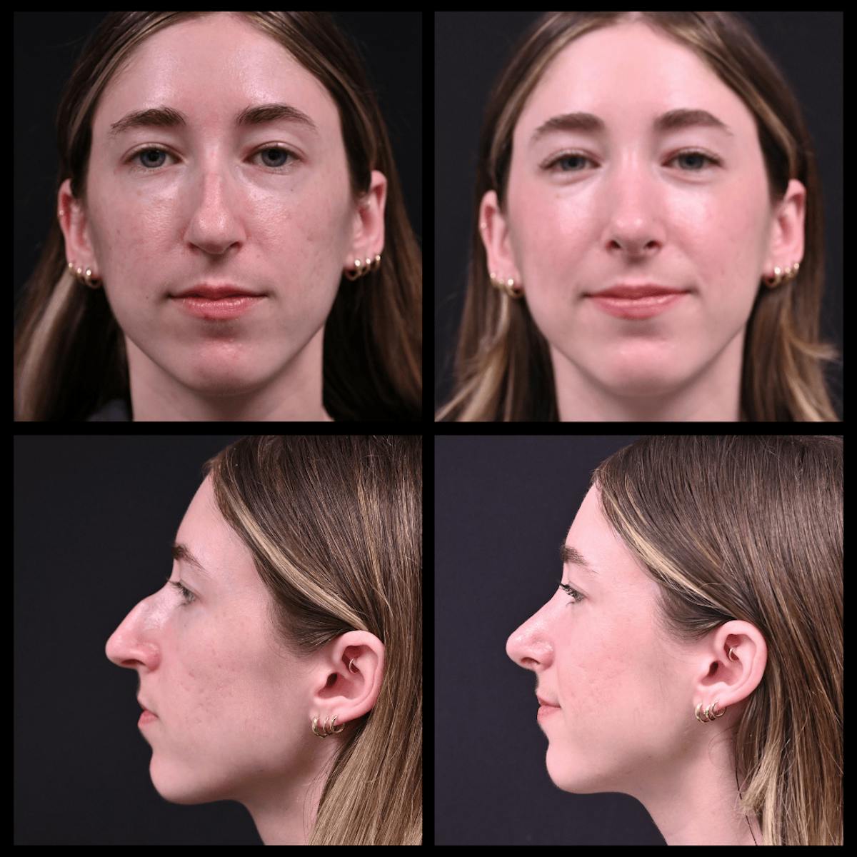 Rhinoplasty (Nose Job) Before & After Gallery - Patient 280909 - Image 1