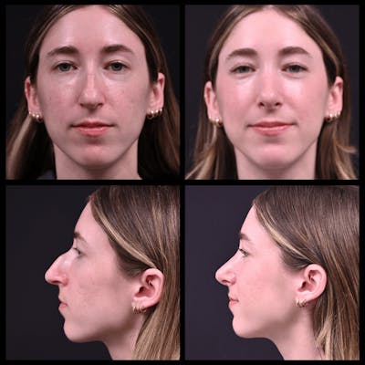 Rhinoplasty (Nose Job) Before & After Gallery - Patient 280909 - Image 1