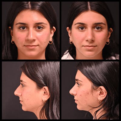 Rhinoplasty (Nose Job) Before & After Gallery - Patient 328337 - Image 1