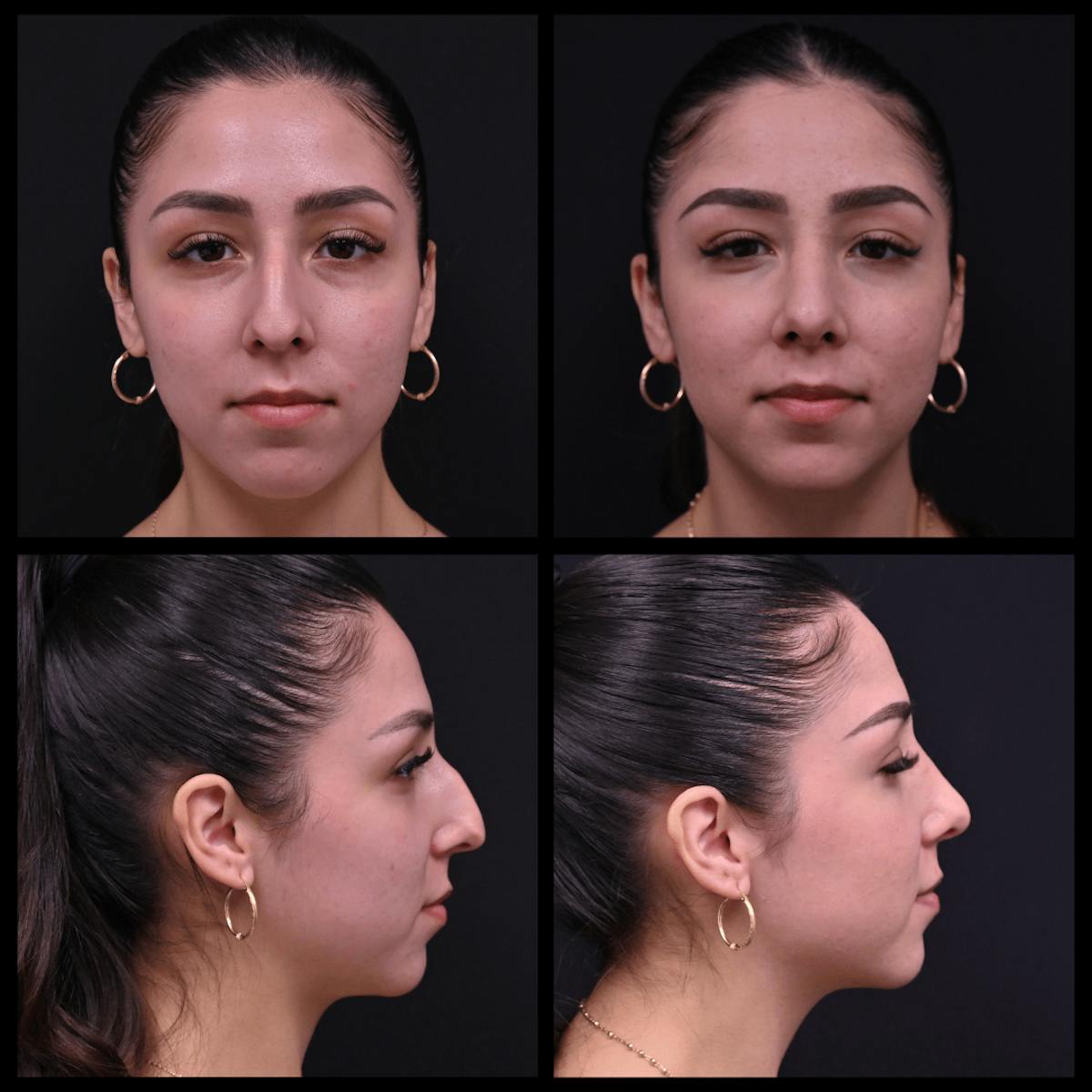 Rhinoplasty (Nose Job) Before & After Gallery - Patient 520504 - Image 1