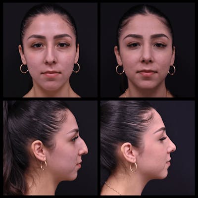 Rhinoplasty (Nose Job) Before & After Gallery - Patient 520504 - Image 1