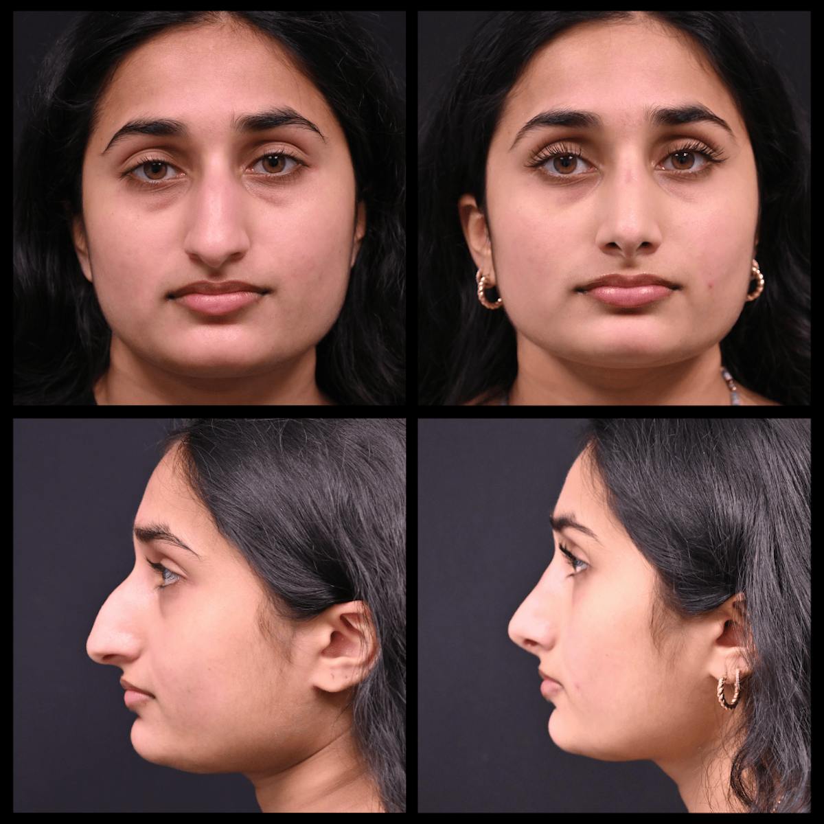 Rhinoplasty (Nose Job) Before & After Gallery - Patient 422742 - Image 1