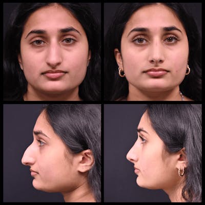 Rhinoplasty (Nose Job) Before & After Gallery - Patient 422742 - Image 1