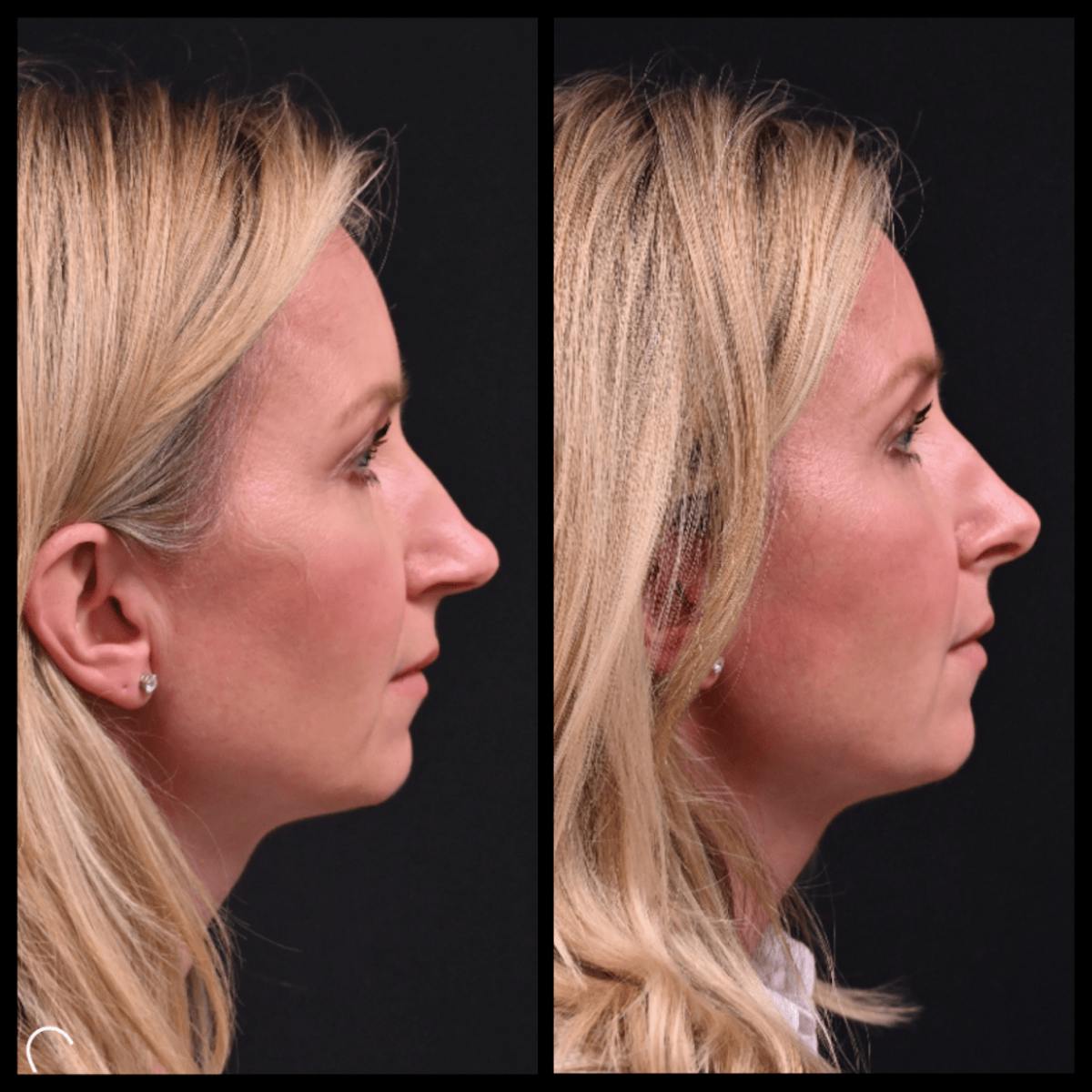 Rhinoplasty (Nose Job) Before & After Gallery - Patient 839440 - Image 1