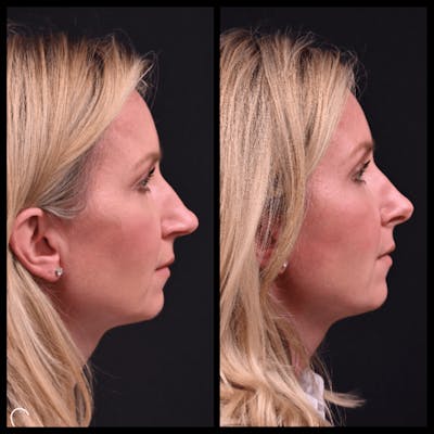 Rhinoplasty (Nose Job) Before & After Gallery - Patient 839440 - Image 1