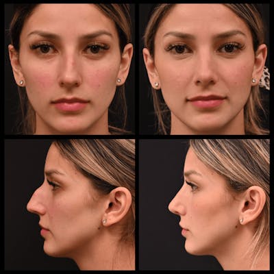 Rhinoplasty (Nose Job) Before & After Gallery - Patient 993829 - Image 1