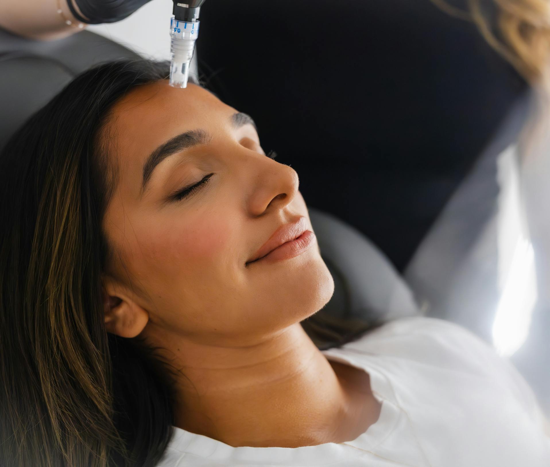 microneedling