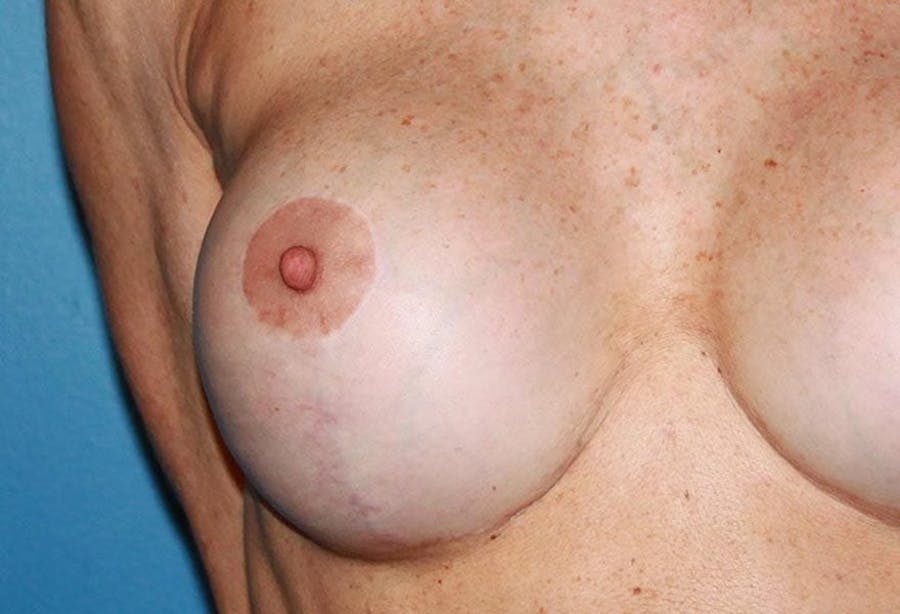 breast lift results