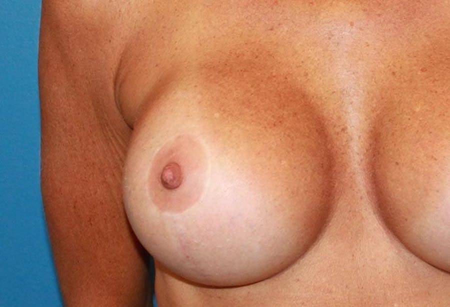 breast lift results