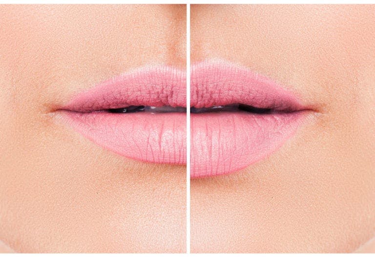 side by side of lips before and after filler