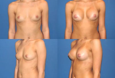 Large B Cup Augmentation Before & After Gallery - Patient MVzz65c1SdK39tcfBsFOXA - Image 1