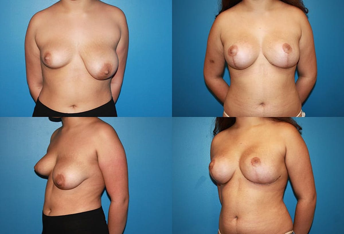 Reductive Augmentation of the Breast Before & After Gallery - Patient 181114 - Image 1