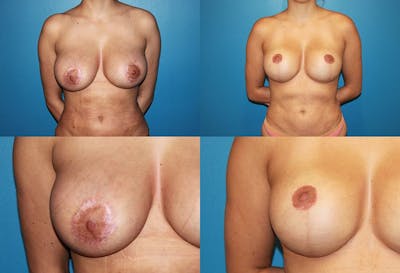 Enlarged Areola Before & After Gallery - Patient 223159 - Image 1