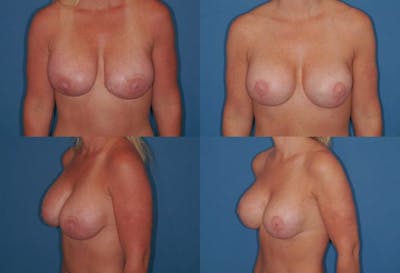 Enlarged Areola Before & After Gallery - Patient 120946 - Image 1