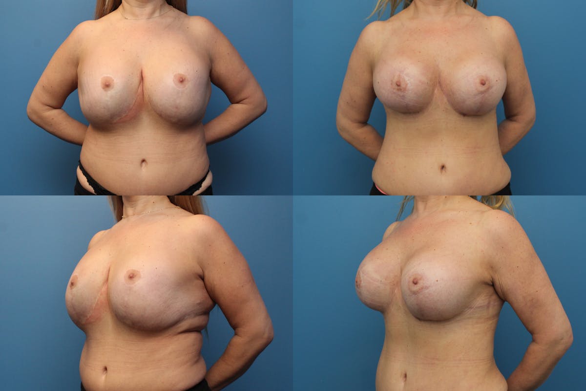 Reductive Augmentation of the Breast Before & After Gallery - Patient 196384 - Image 1