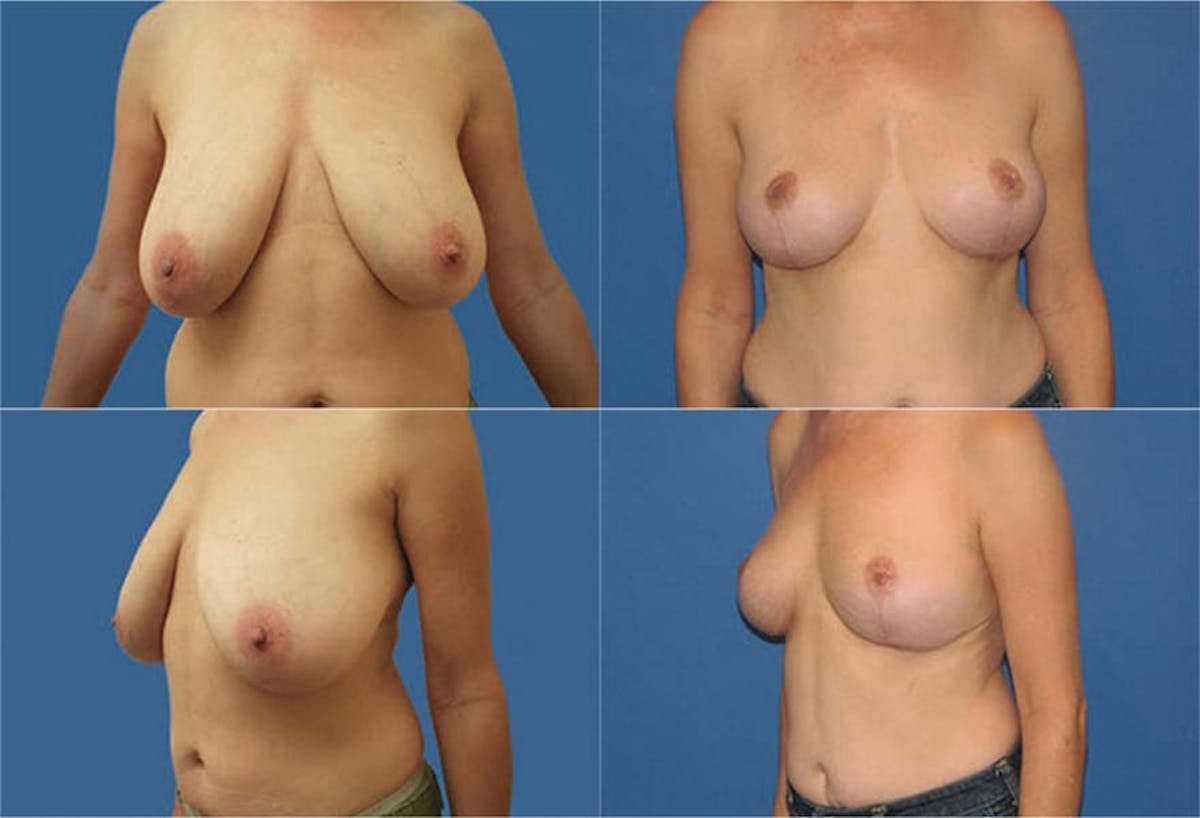 Breast Reduction Before & After Gallery - Patient 352459 - Image 1