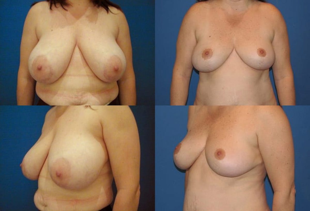 Breast Reduction Before & After Gallery - Patient 105316 - Image 1