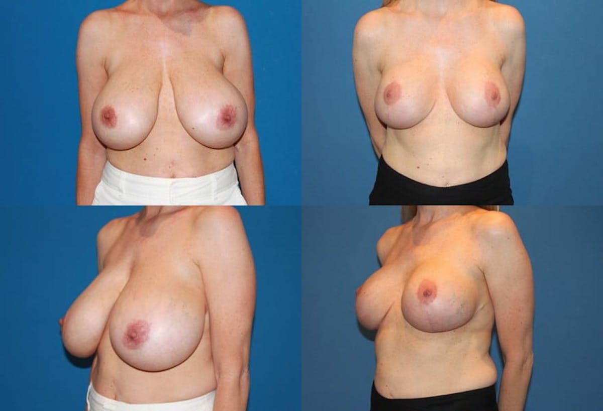 Breast Reduction Before & After Gallery - Patient 298691 - Image 1