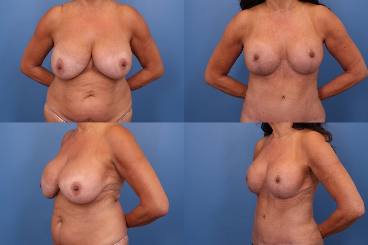 Reductive Augmentation of the Breast Before & After Gallery - Patient 258209 - Image 1