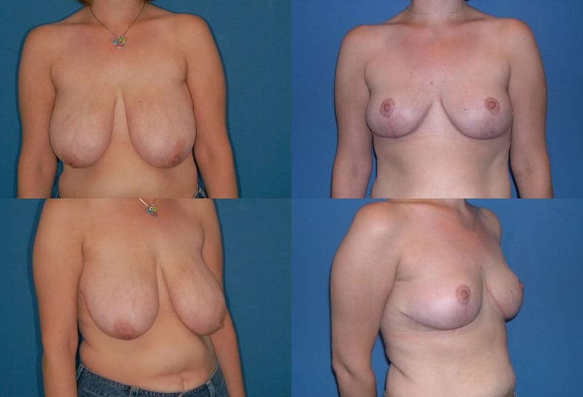 Breast Reduction Before & After Gallery - Patient 114504 - Image 1