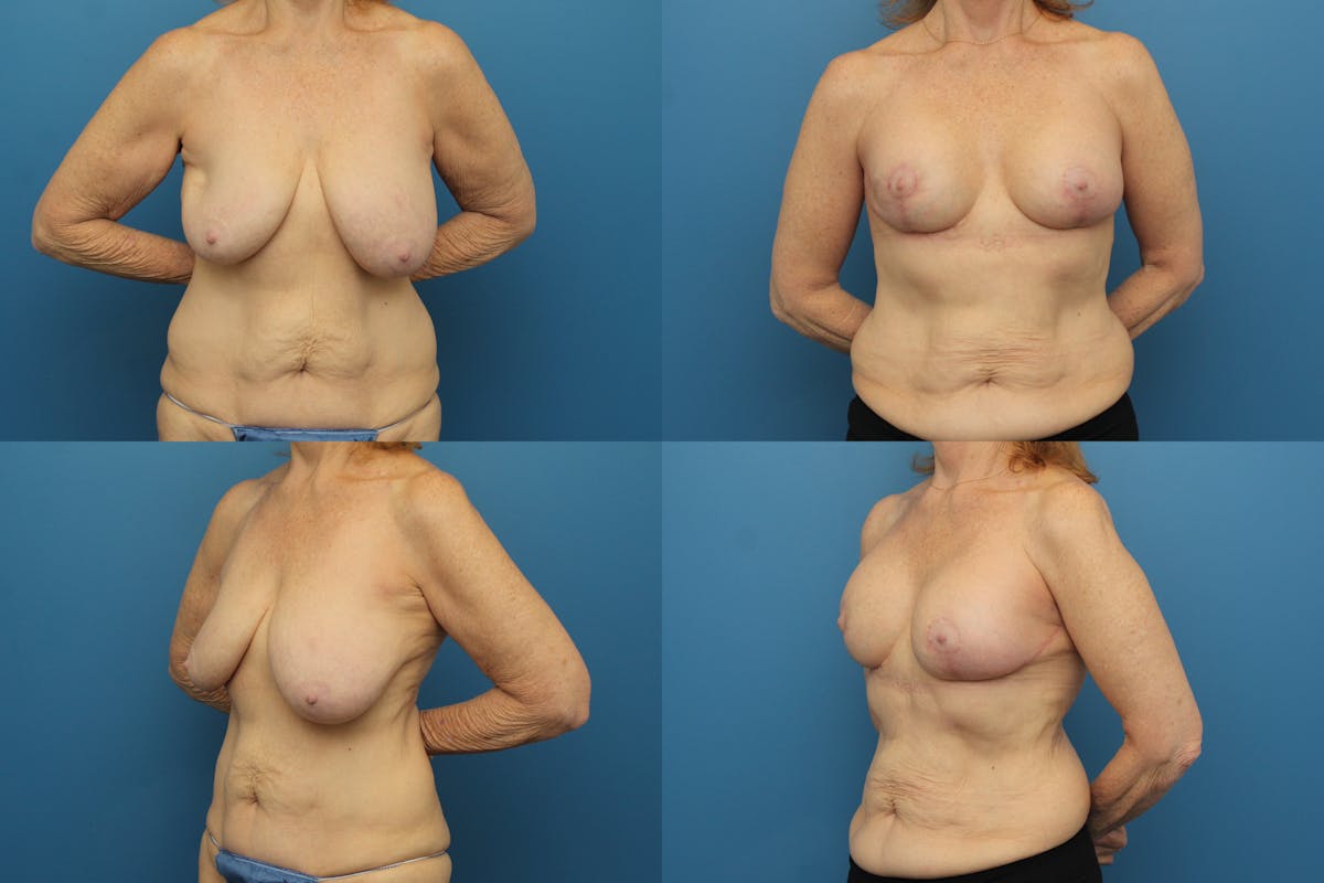 Reductive Augmentation of the Breast Before & After Gallery - Patient 720736 - Image 1