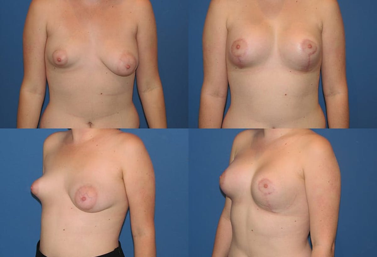 Tubular Breast Before & After Gallery - Patient 216928 - Image 1