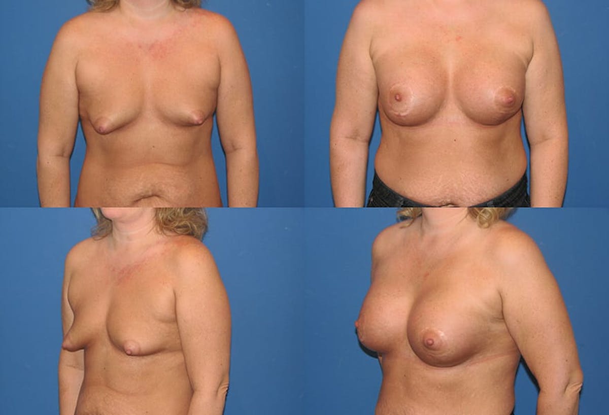 Tubular Breast Before & After Gallery - Patient 198263 - Image 1