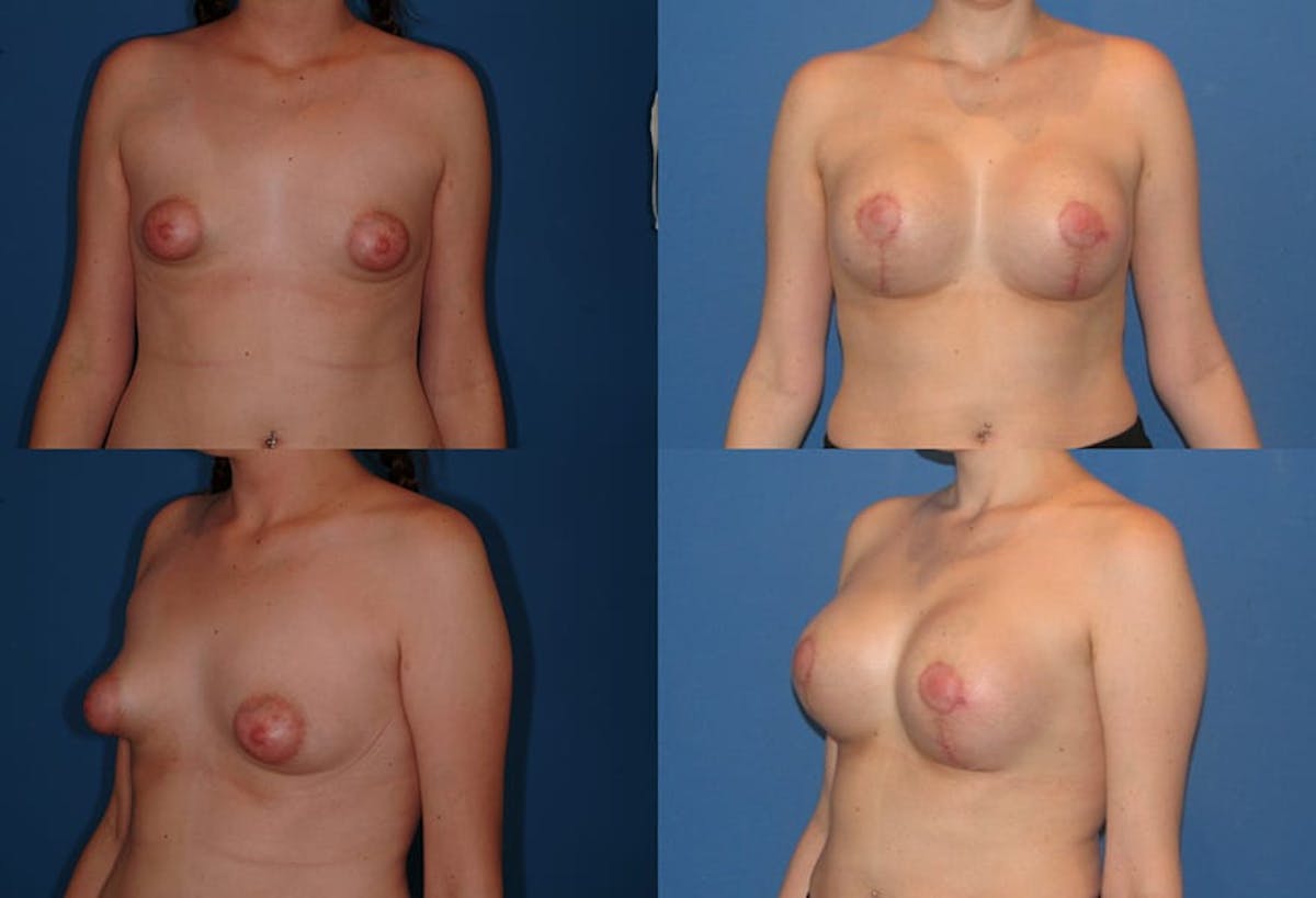Tubular Breast Before & After Gallery - Patient 136230 - Image 1