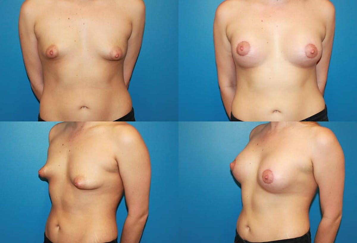 Tubular Breast Before & After Gallery - Patient 396899 - Image 1