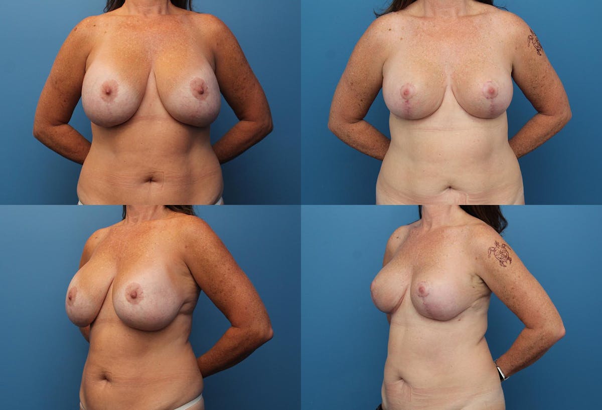 Reductive Augmentation of the Breast Before & After Gallery - Patient 552972 - Image 1