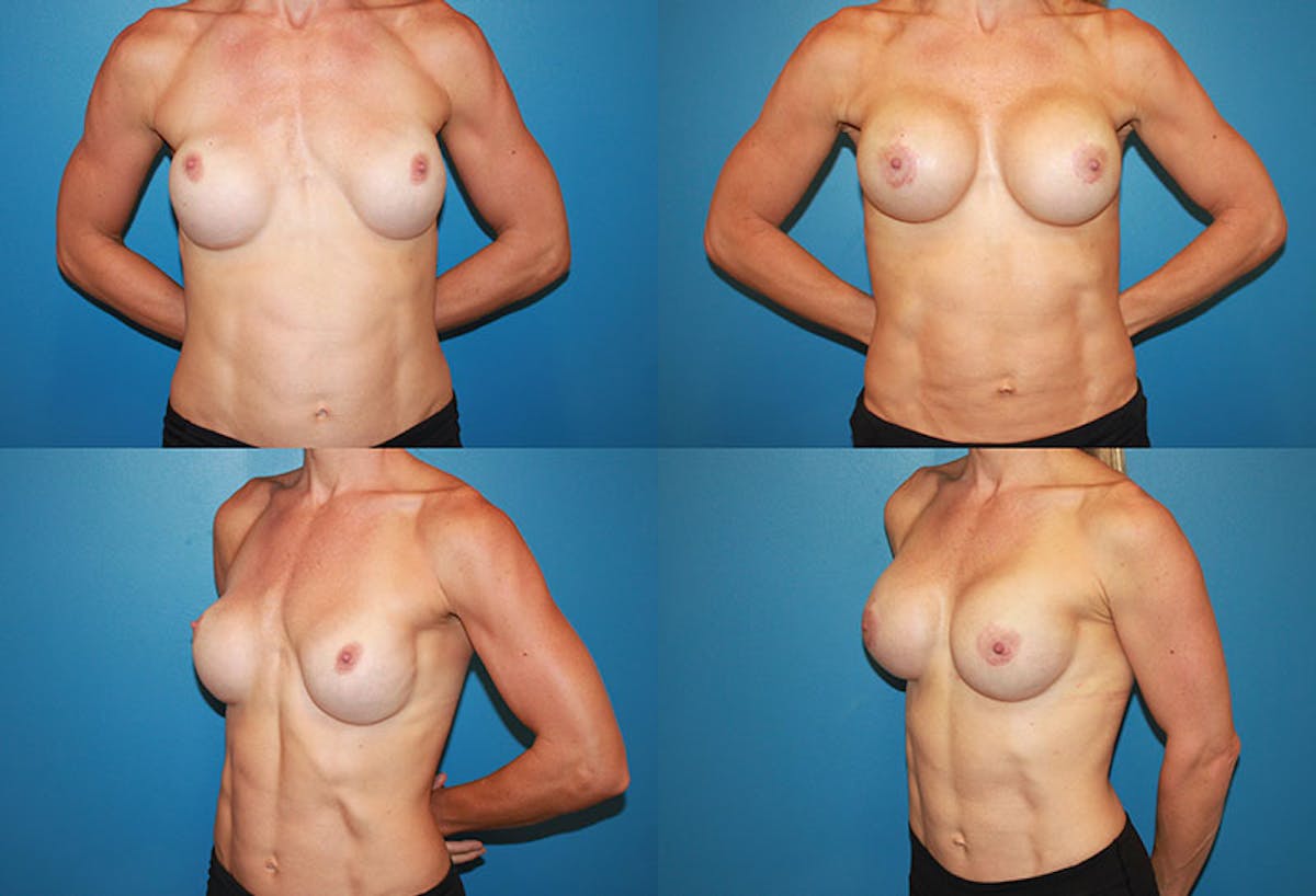 Body Building/Figure & Fitness Before & After Gallery - Patient 397356 - Image 1