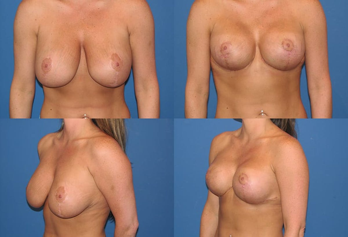 Reductive Augmentation of the Breast Before & After Gallery - Patient 401578 - Image 1
