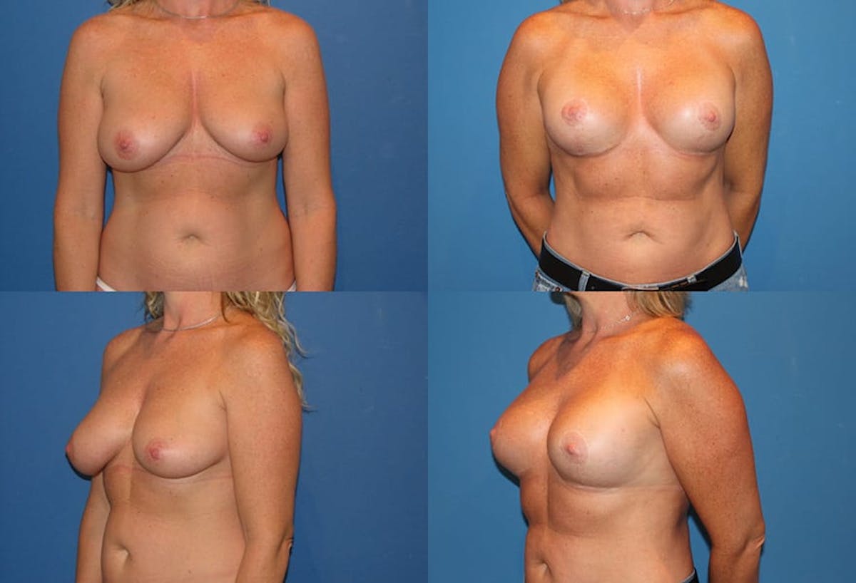 Reductive Augmentation of the Breast Before & After Gallery - Patient 746304 - Image 1