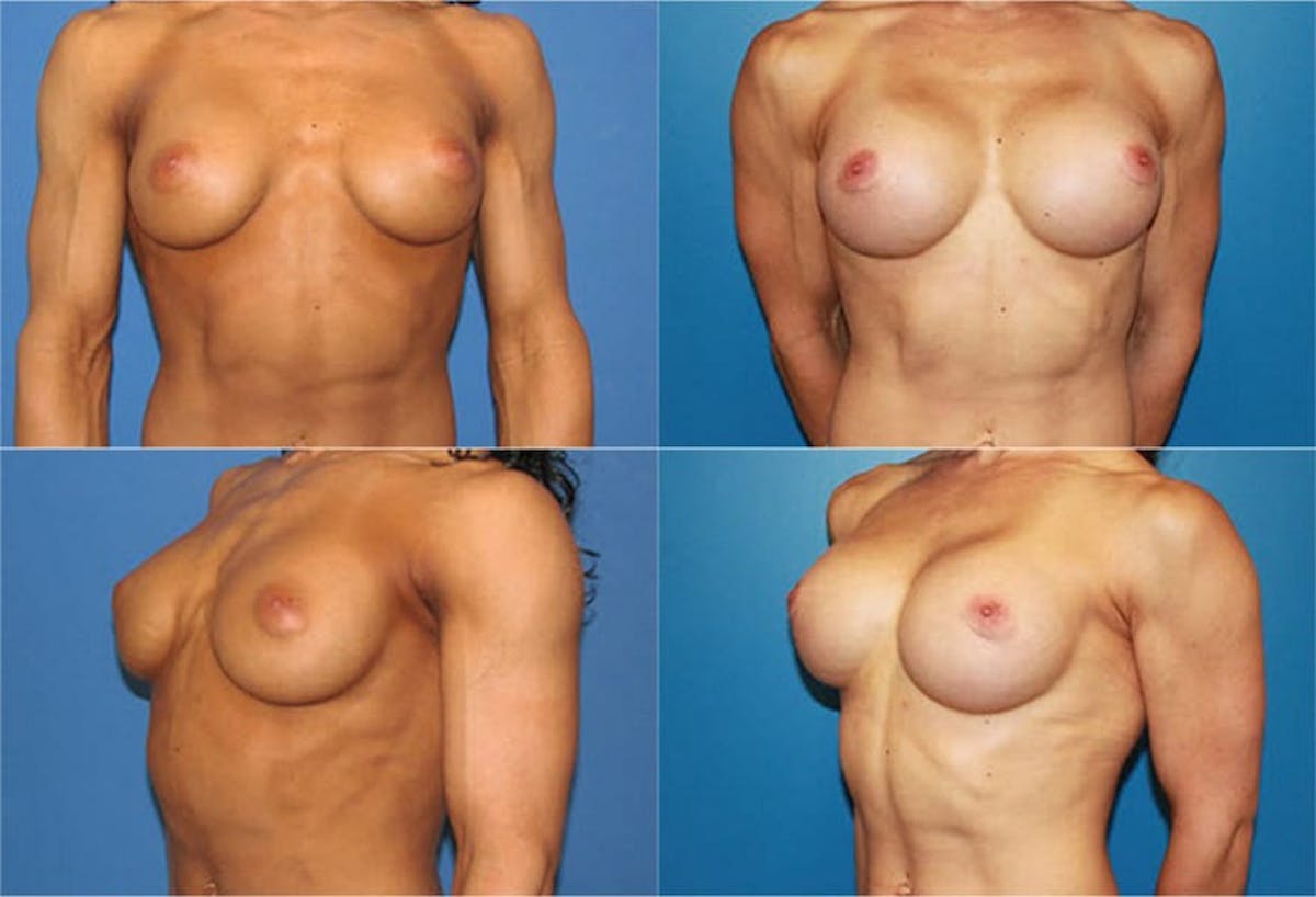 Body Building/Figure & Fitness Before & After Gallery - Patient 237813 - Image 1