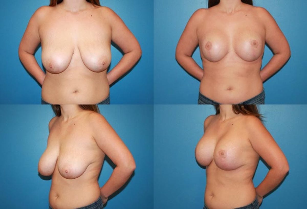 Reductive Augmentation of the Breast Before & After Gallery - Patient 397873 - Image 1