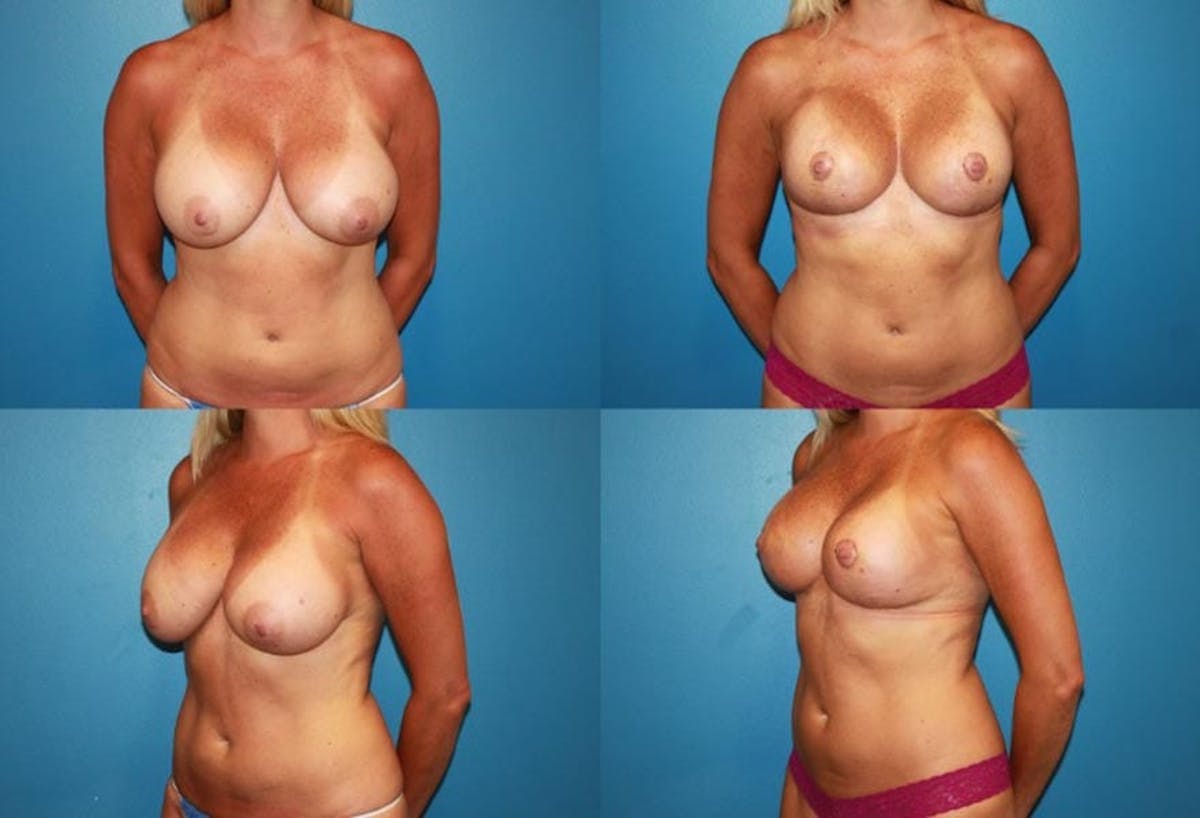 Reductive Augmentation of the Breast Before & After Gallery - Patient 791544 - Image 1