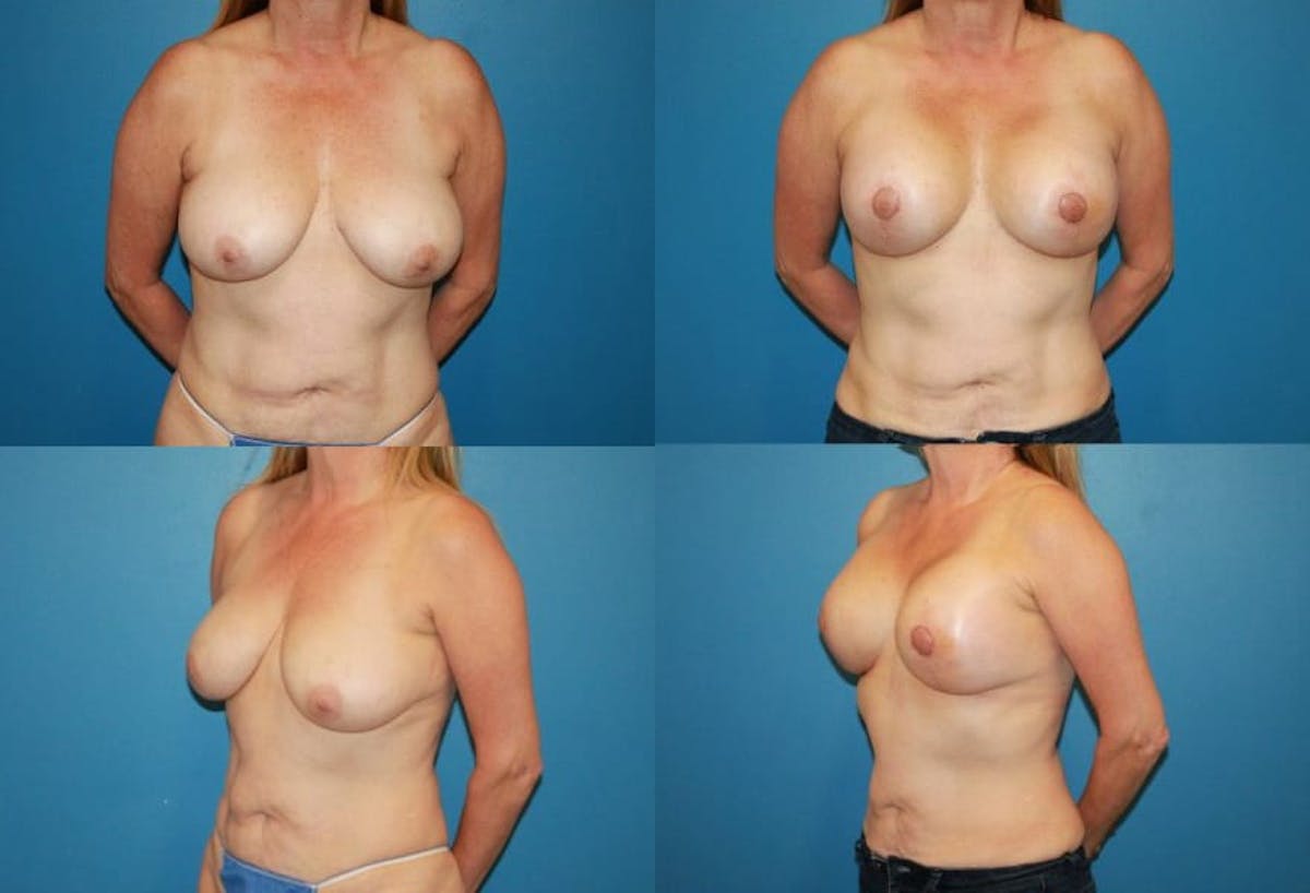 Reductive Augmentation of the Breast Before & After Gallery - Patient 311727 - Image 1