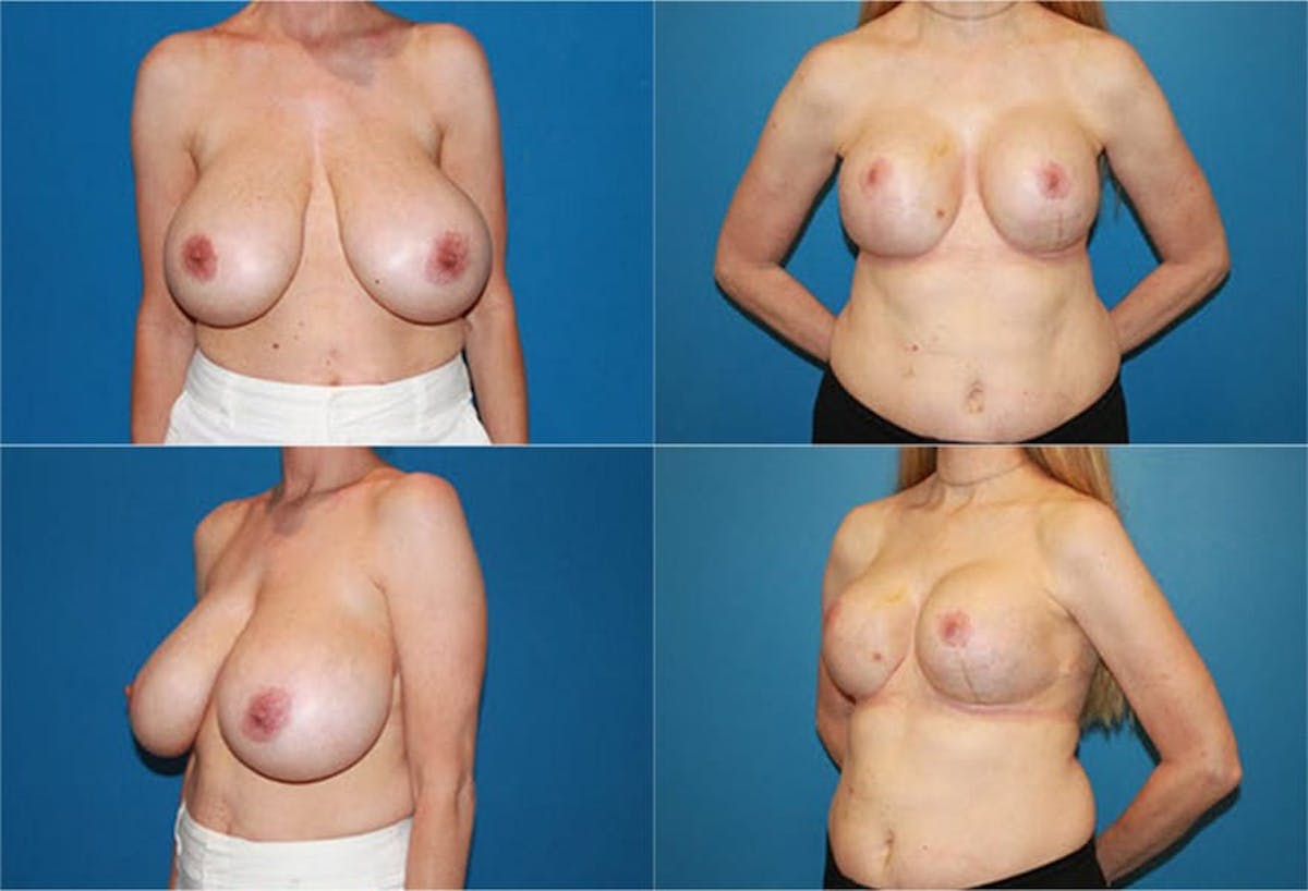 Reductive Augmentation of the Breast Before & After Gallery - Patient 400717 - Image 1