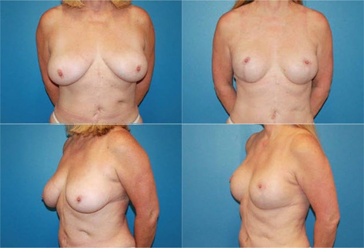 Reductive Augmentation of the Breast Before & After Gallery - Patient 147817 - Image 1
